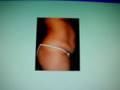 عمليات تجميل وشد البطن-tummy tuck-abdominoplasty